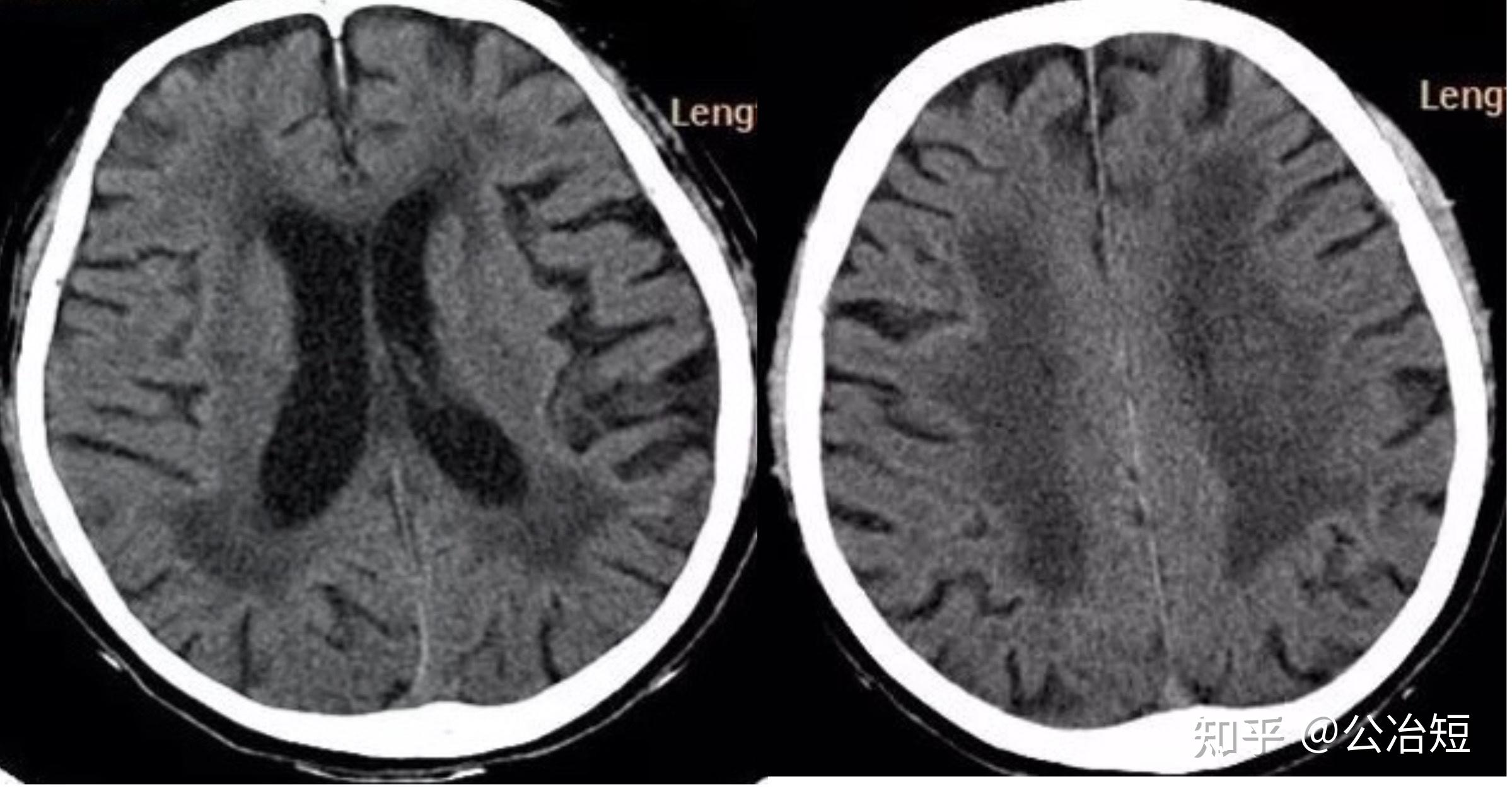 MRI 报告中的脱髓鞘与脑白质疏松诊断的辨析 - 知乎