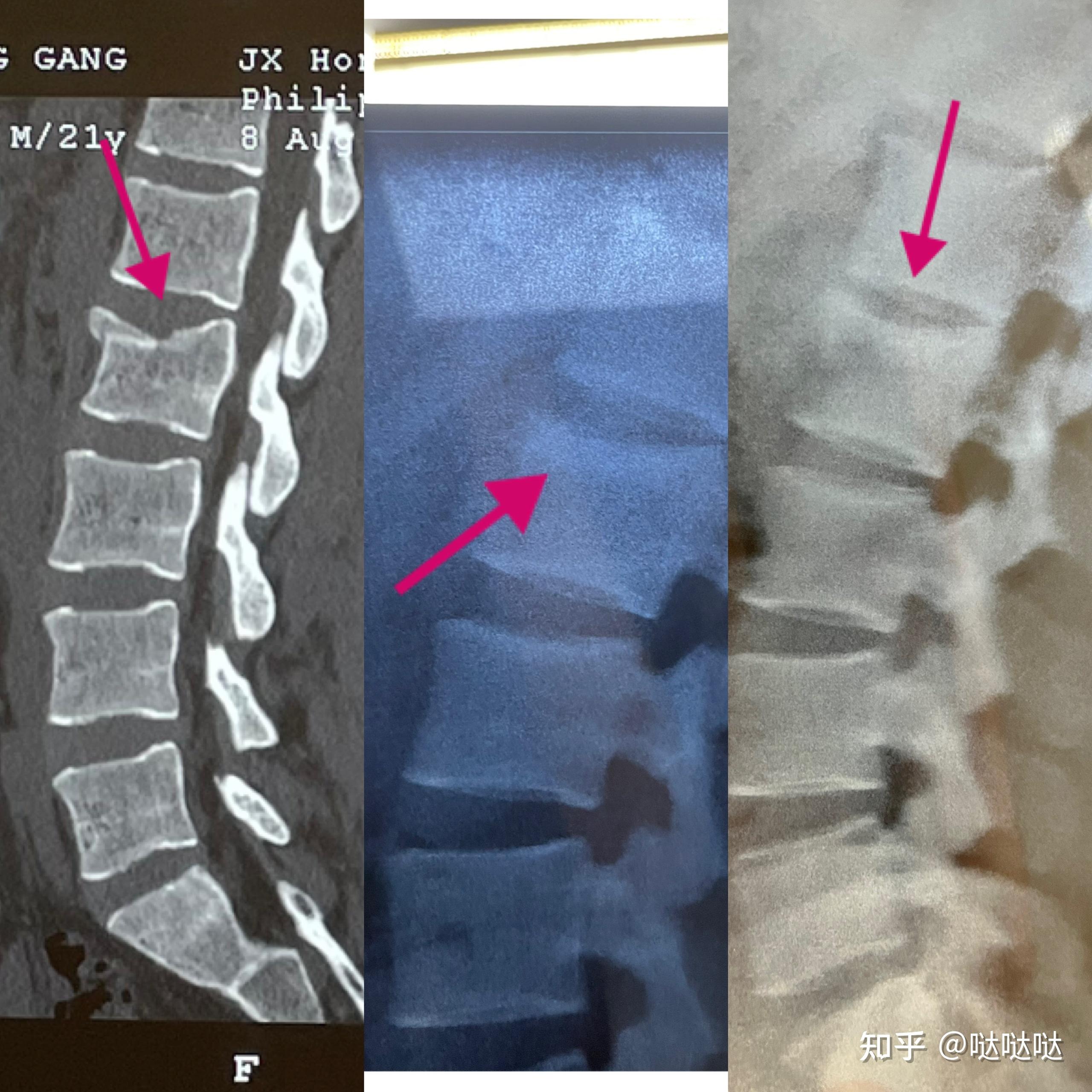 腰椎骨折片子图片
