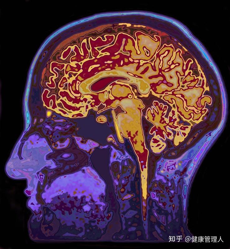 脑供血不足的表现及对策