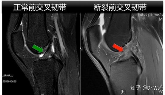 前十字交叉韧带撕裂图片