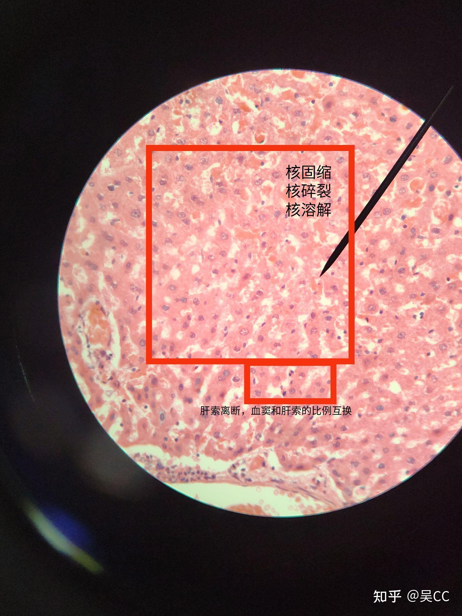 肝索镜下图片图片