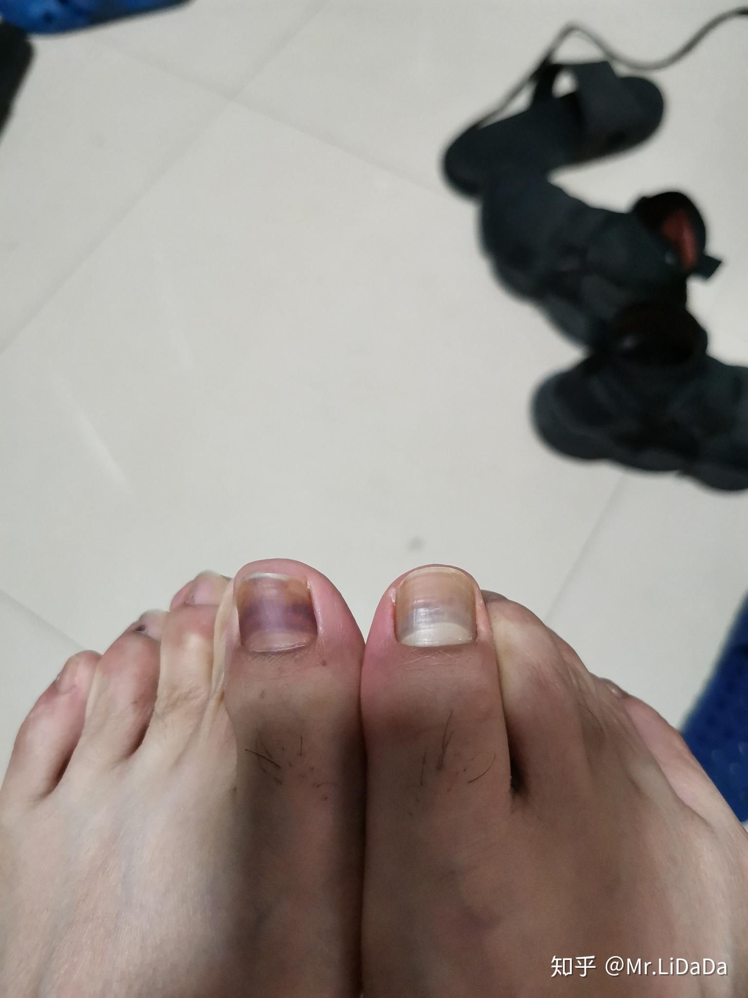 打篮球脚趾甲里面有淤血? - 知乎