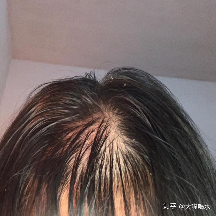 头顶稀疏怎么让头发变多我不想再掉头发了