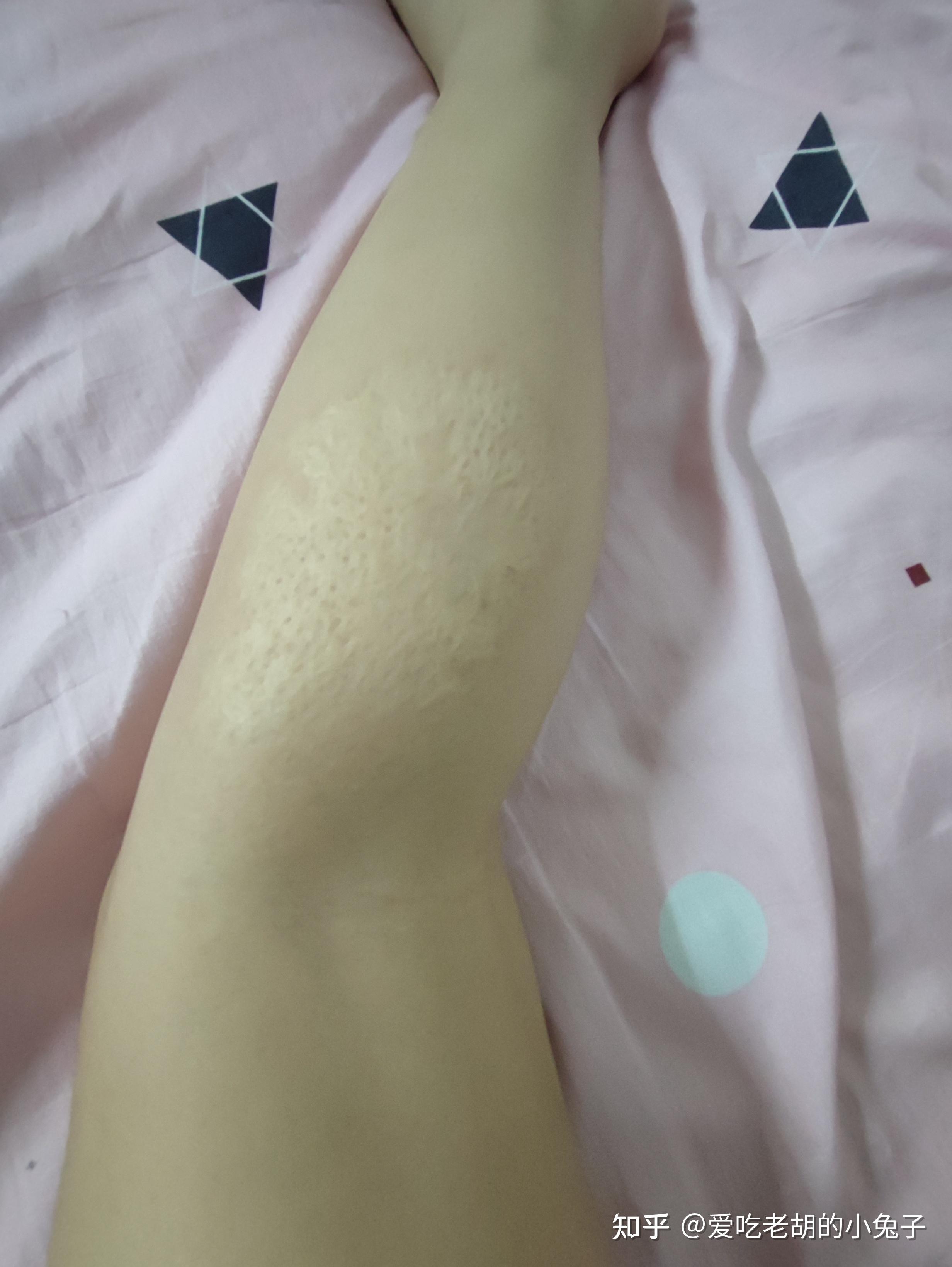 腿上有疤的女孩子都勇敢突破自己了吗