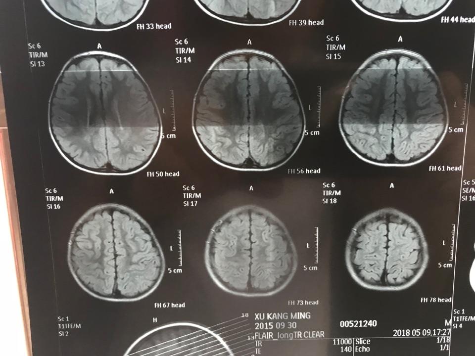 磁共振,双侧半卵圆中心及侧脑室后角旁白质异常信号,考虑扩大的血管