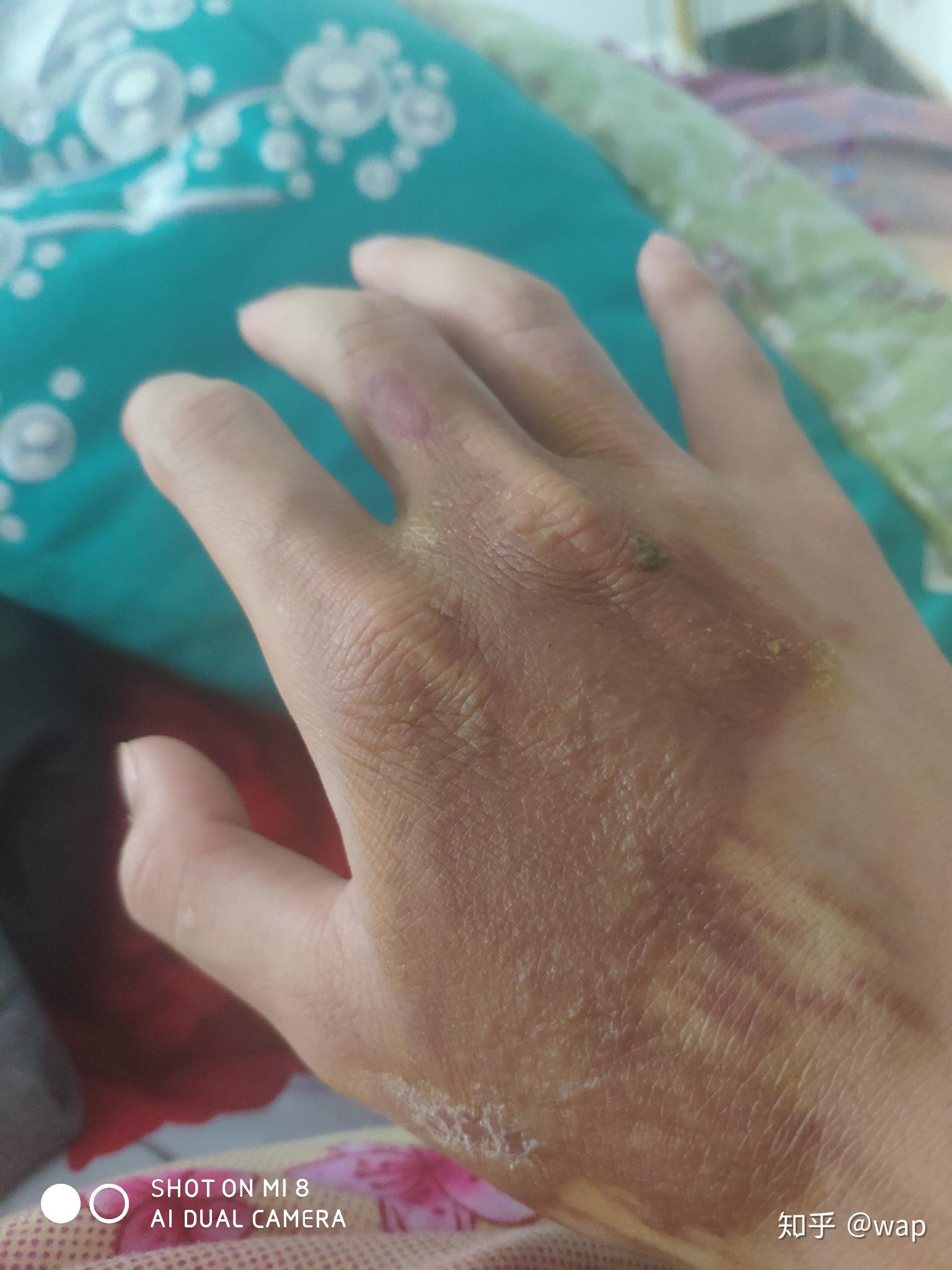 手背开水烫伤怎么恢复