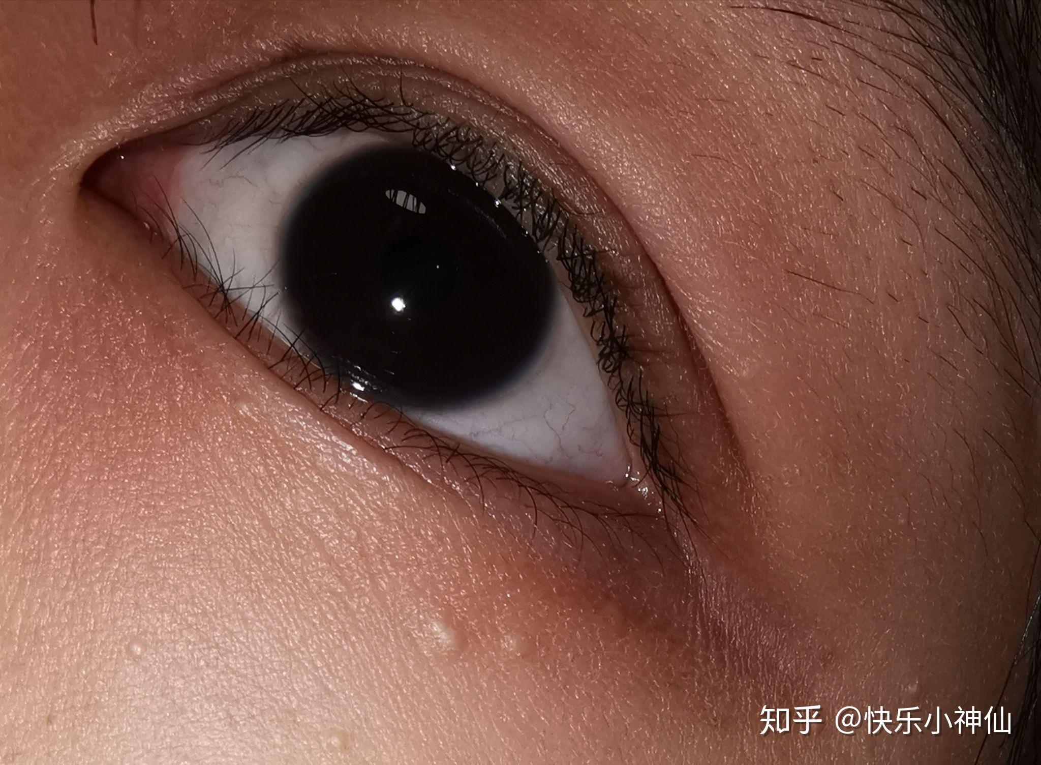 什么是双睫症身边有这样的朋友吗