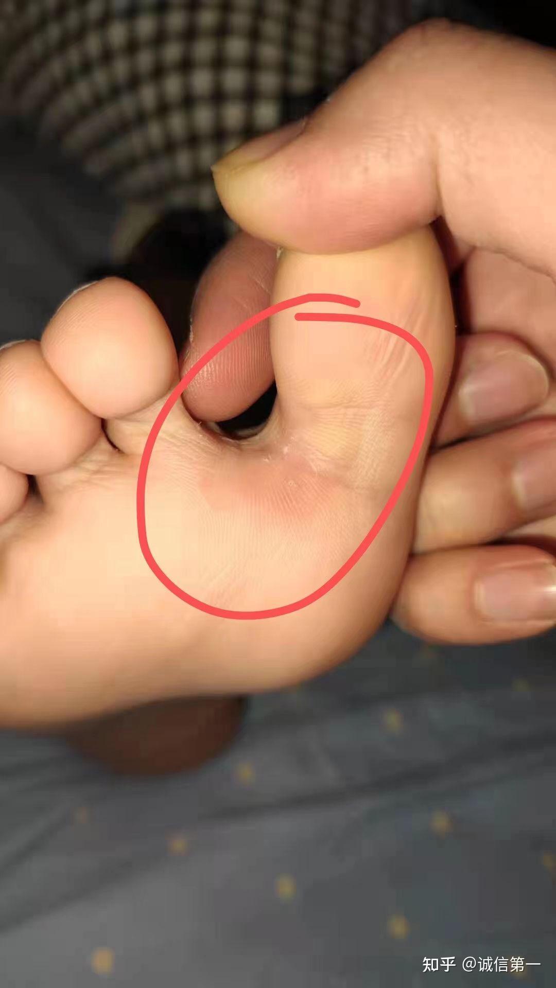 跎疣怎么形成的?