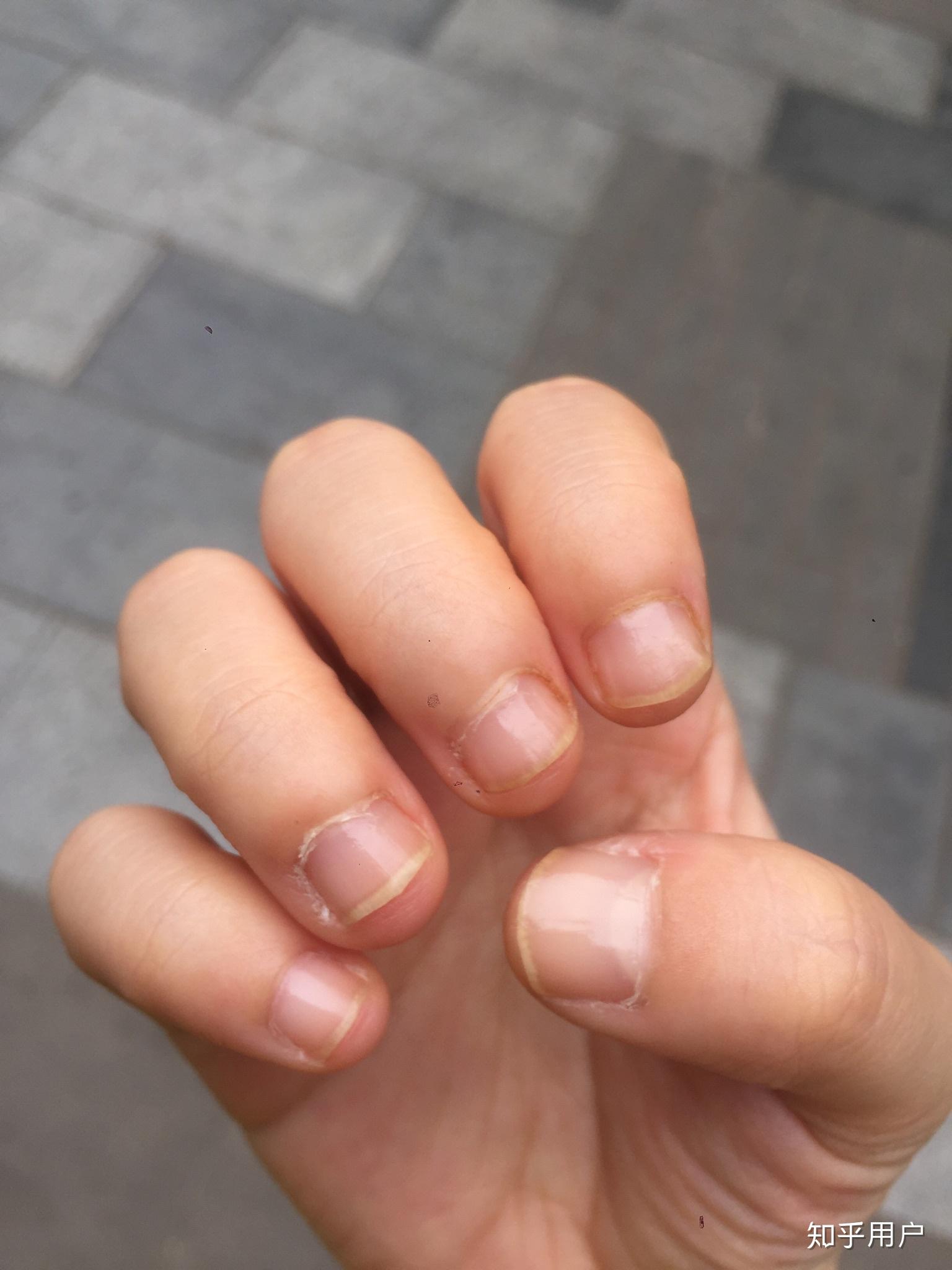 甲床过短应该如何变长? - 知乎