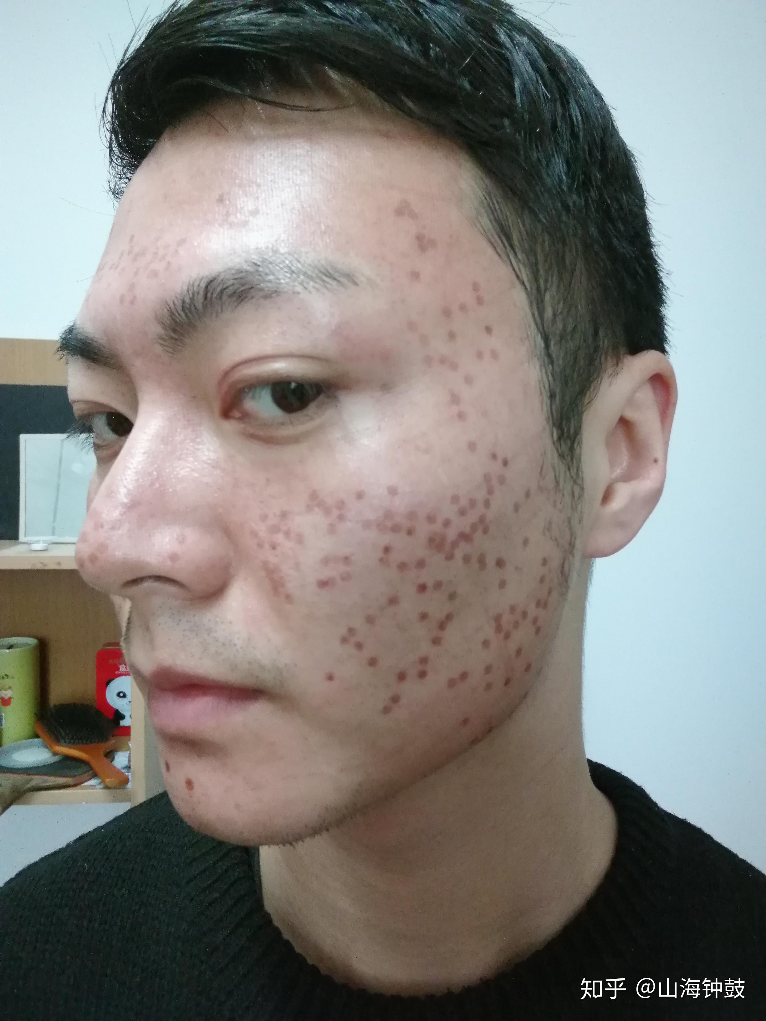 记录一下自己第一次co2点阵激光手术后的恢复情况