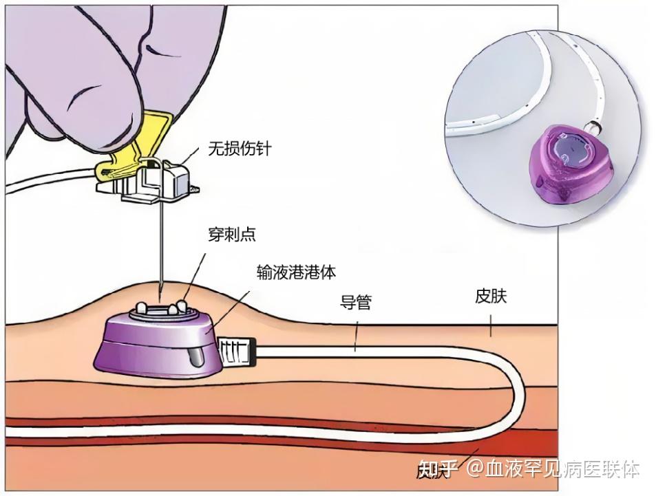 穿刺杆 通道图片