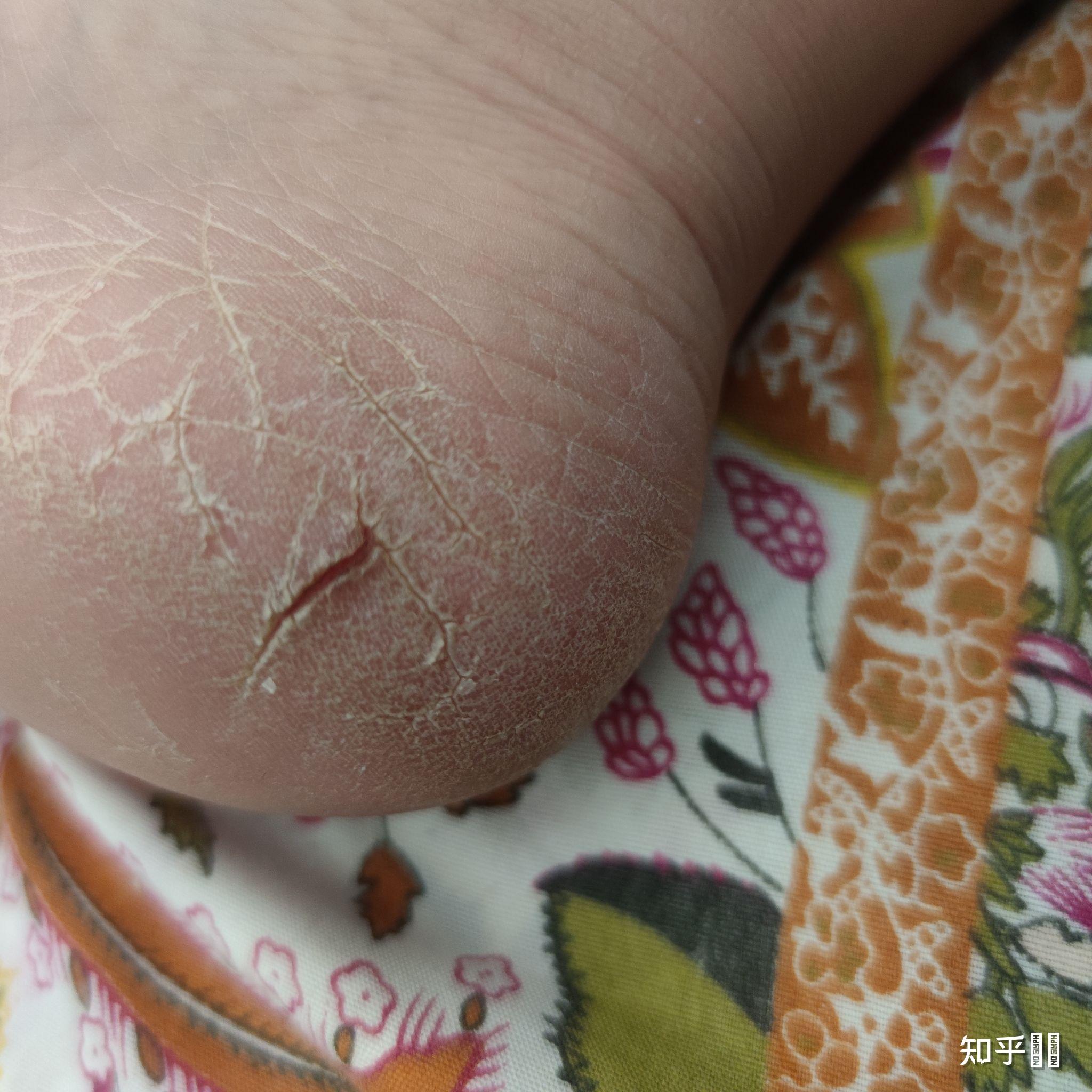 皮肤变硬严重皲裂反复了一年是湿疹吗