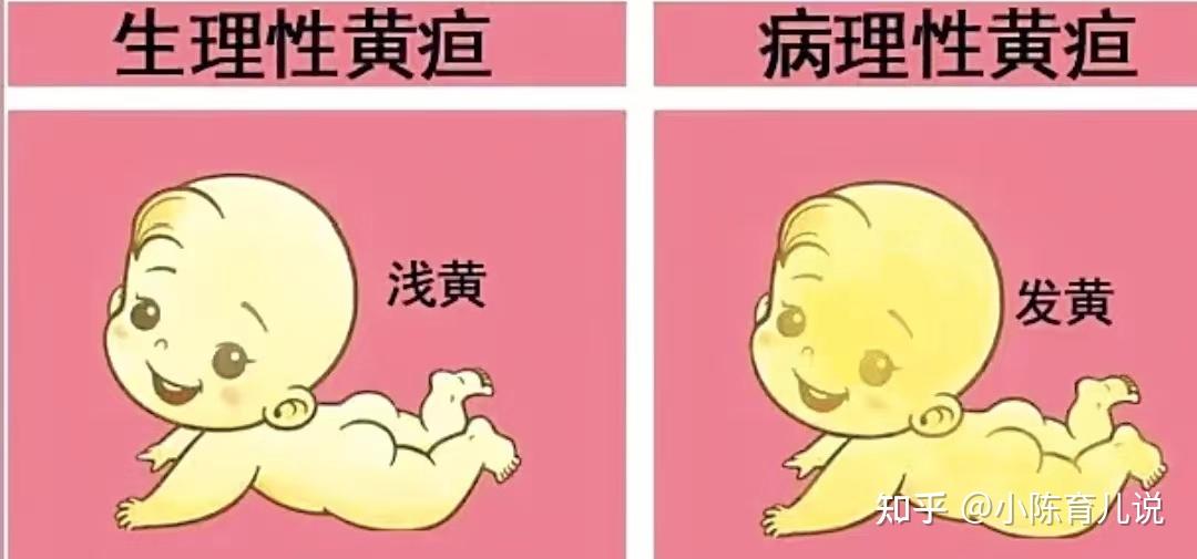 什么是新生儿黄疸?该如何处理? - 知乎