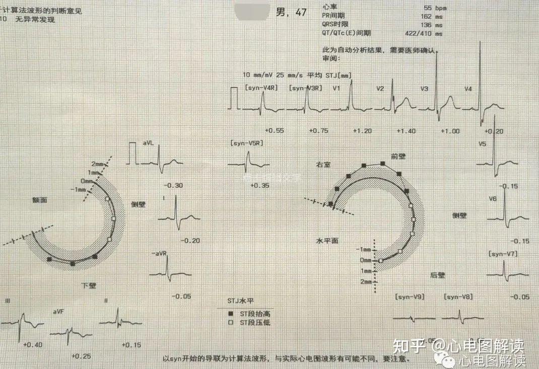 完全性右束支阻滯在12導聯及右胸導聯的表現