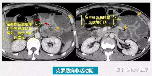 炎症性肠病为何需要影像学检查 看仁济医院教授怎么说 知乎