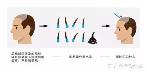 植发的效果怎么样，成都植发有靠谱的公立医院医生推荐吗？