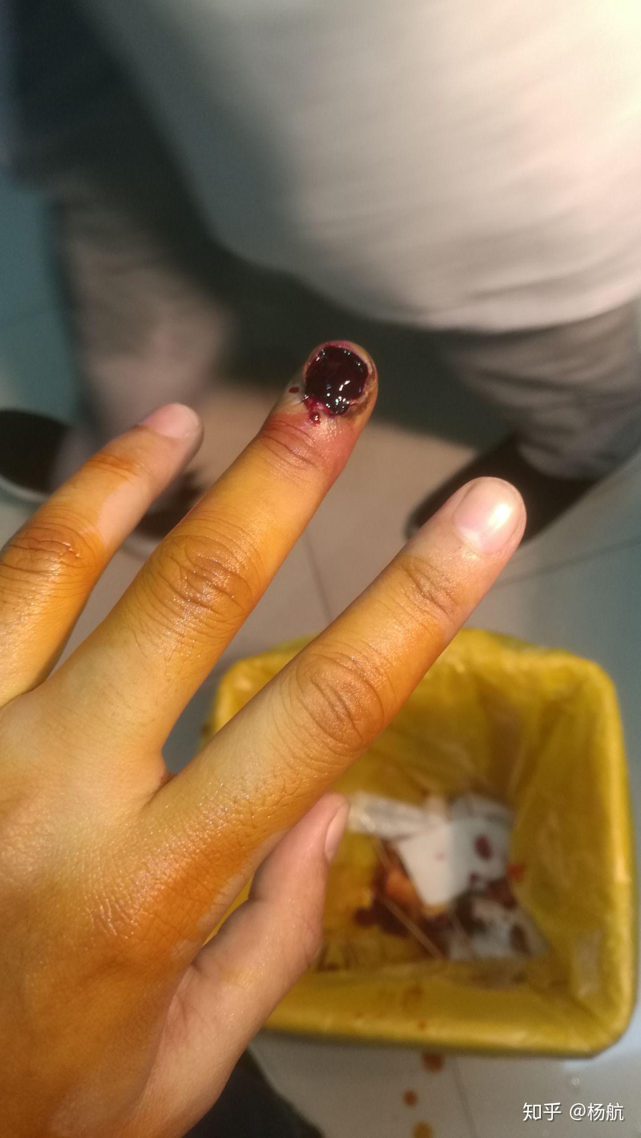 甲沟炎拔甲是怎样的体验