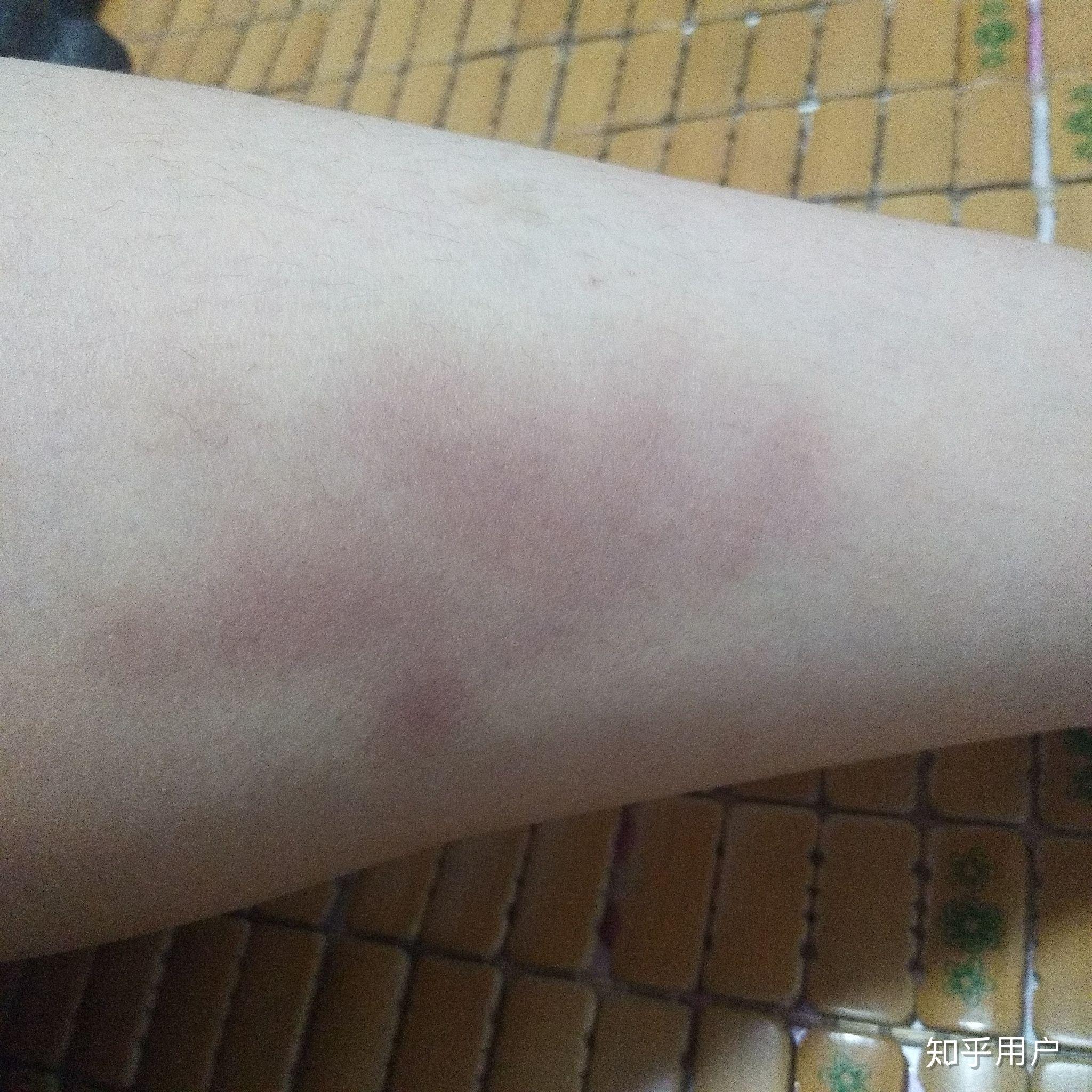 请问使用泡沫轴按摩大腿外侧时,出现这样的淤青正常么?