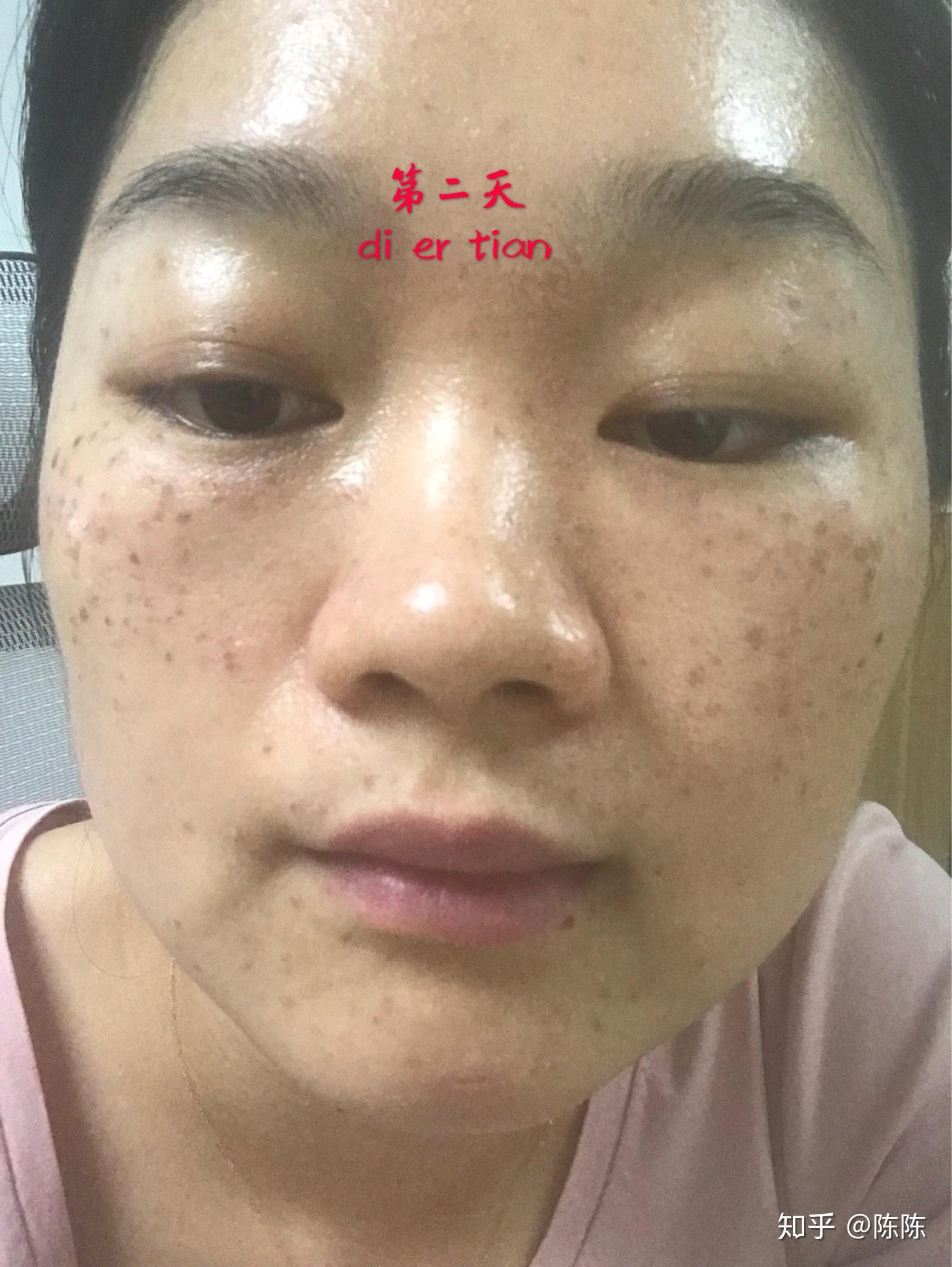 杭州艺星医疗美容医院激光祛斑怎么样_恢复过程_效果如何_氧气8J06e5f整形日记4.3_新氧美容整形