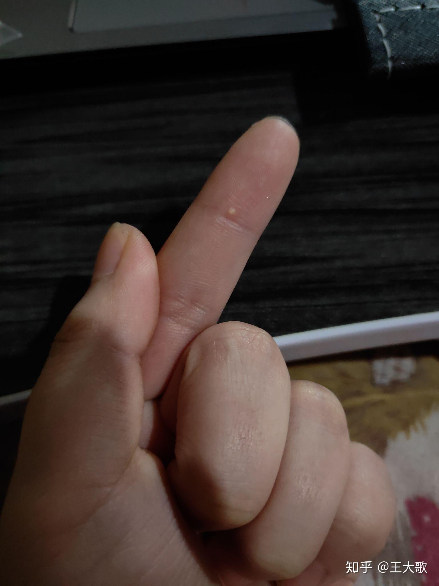 手指上长得这个是什么小包包干的硬硬的一碰就非常痛有图慎入