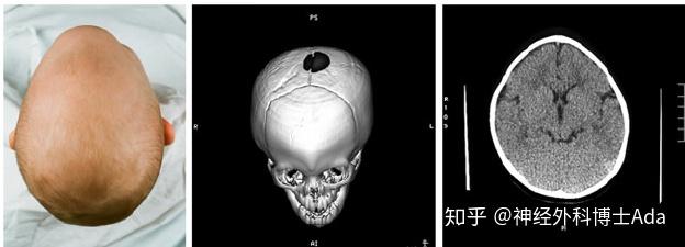 conceziodirocco教授三角头畸形剥壳术手术技巧