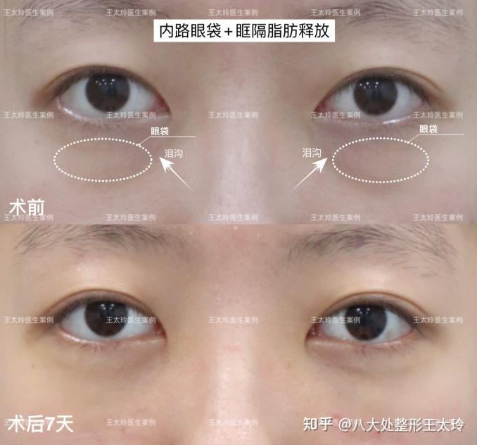 北京内路眼袋+眶隔脂肪释放效果分享 - 知乎