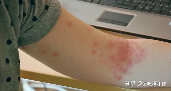 宝宝秋季过敏到底怎么办5条细节收藏好