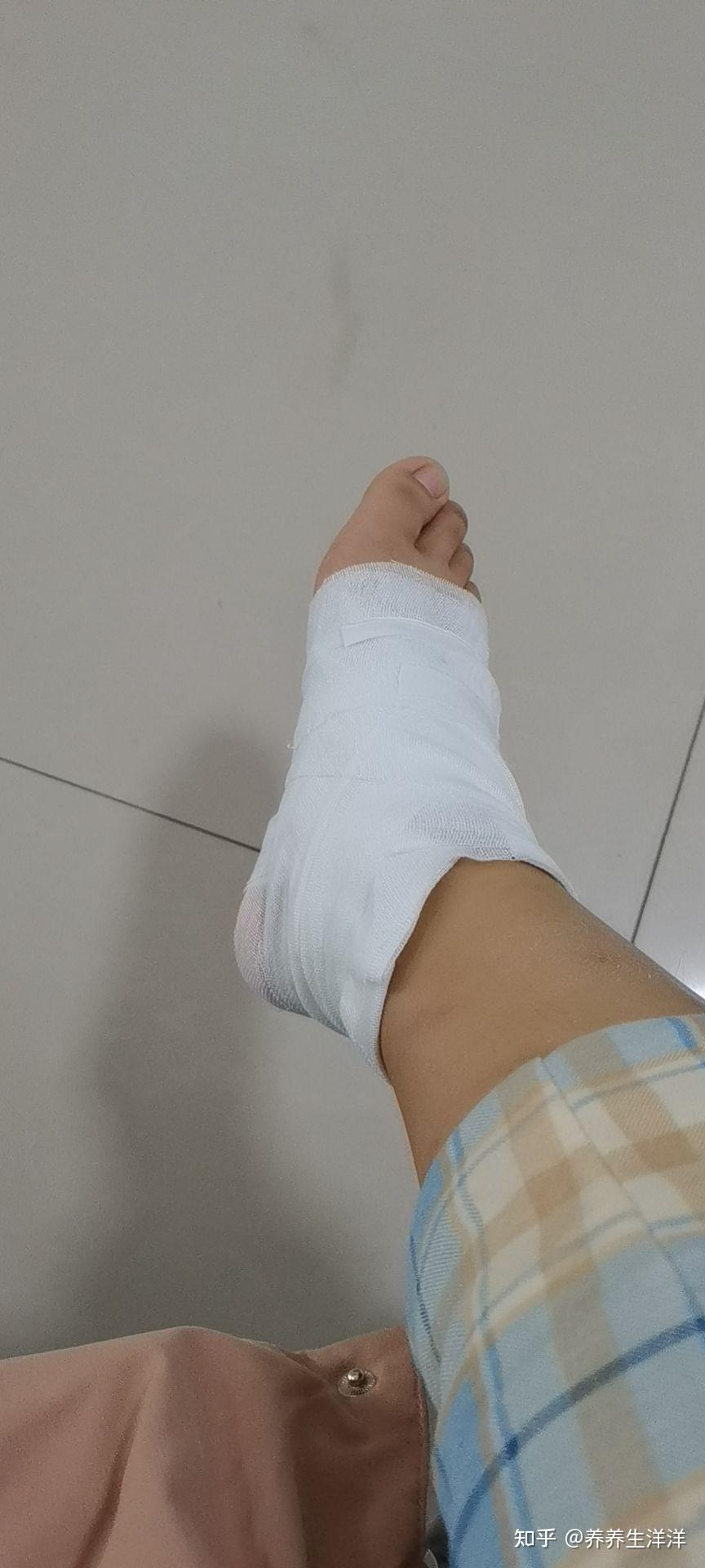 医生把泡弄破了,给我包了起来,叫我第二天去看看是否还需要再度包扎