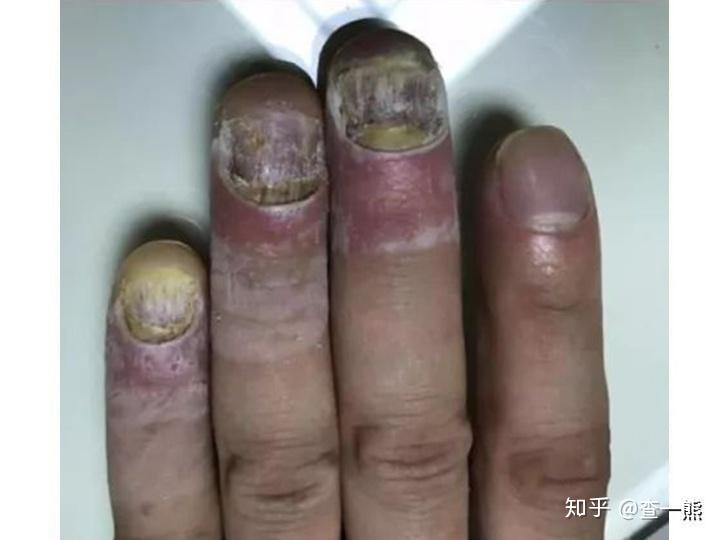 灰指甲被叛死刑的灰指甲如何重焕新生