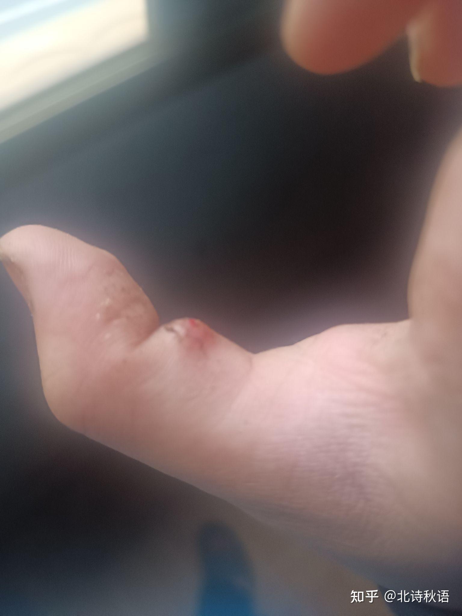 手上长了个包鼓起来,碰一下有点痛感,平常没感觉?