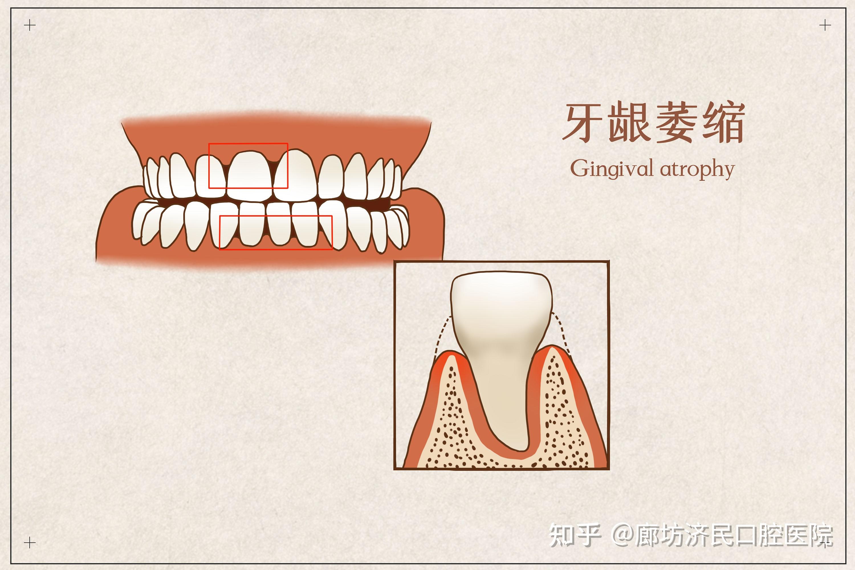 造成牙龈萎缩的几种原因，若及时改正，老了或许依然有一口好牙 - 知乎