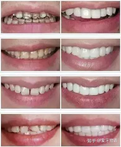 洗牙能让牙变白吗