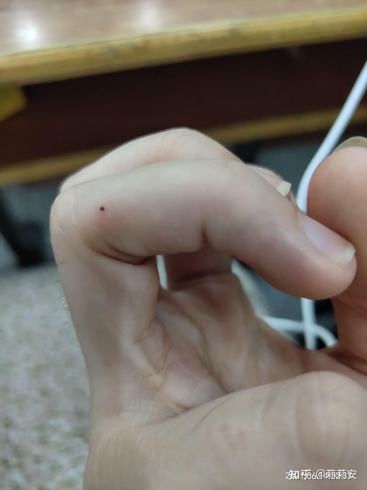 苍蝇(蚊子)屎真的会长在脸上吗? - 知乎