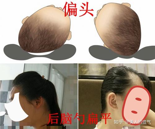 后脑勺睡偏了怎么纠正是不是成年后就改变不了了