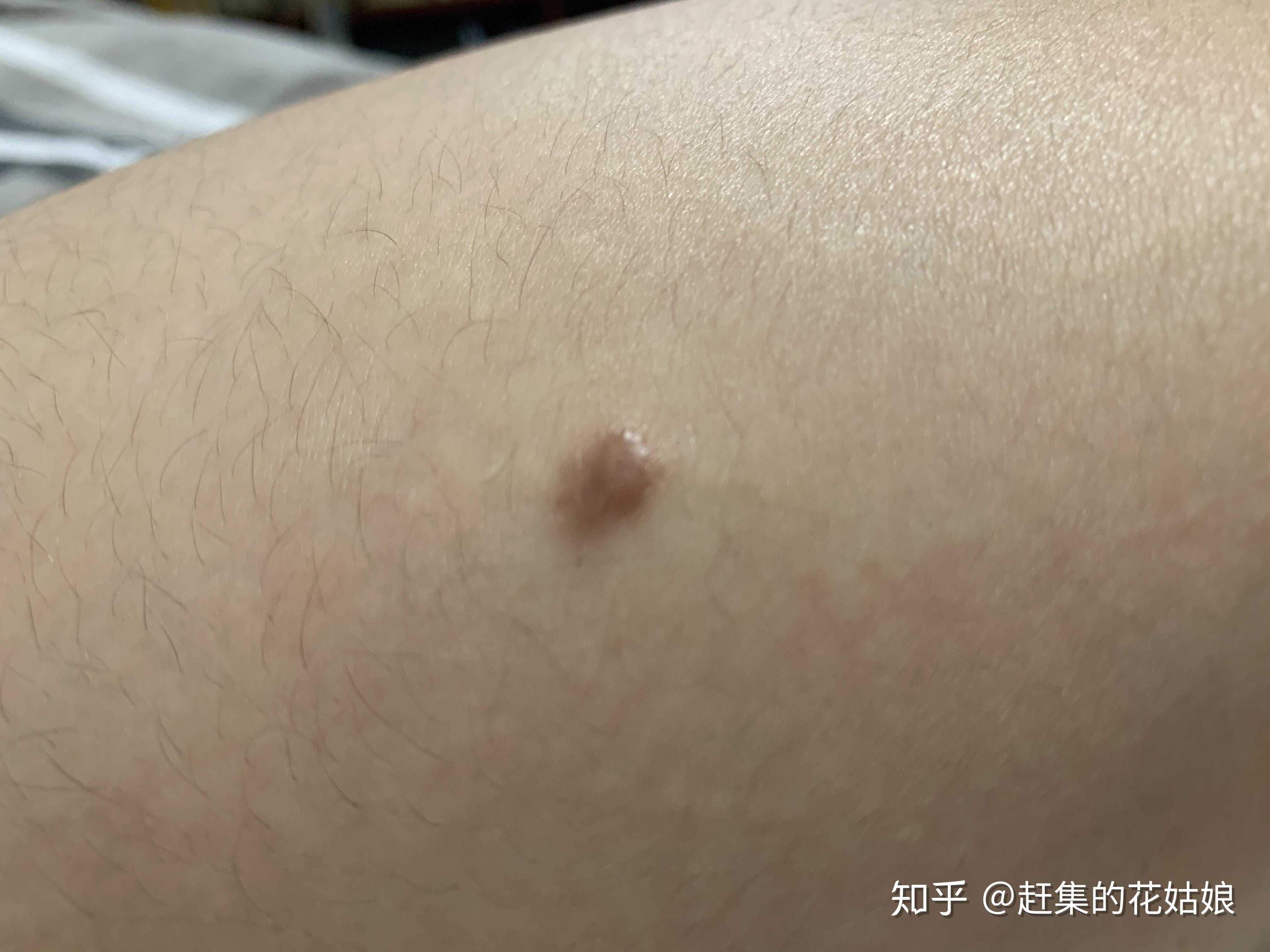 大腿上有个脂肪瘤想去除掉大家有类似情况的吗