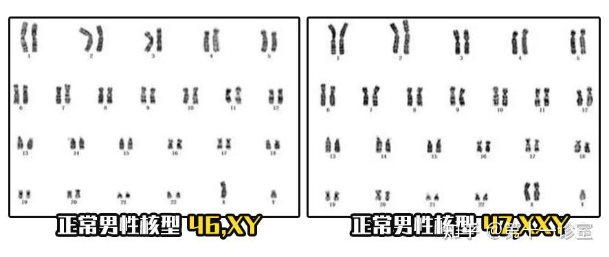 高瘦长腿的男生,可能不是基因好,而是得了这种病! - 知乎