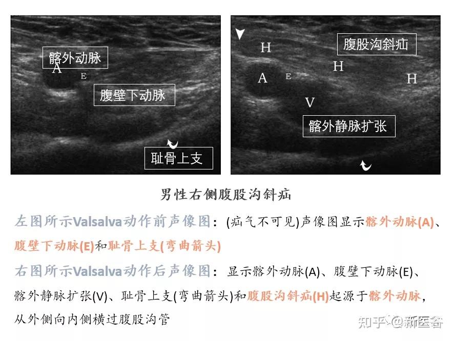 腹股沟疝超声描述图片