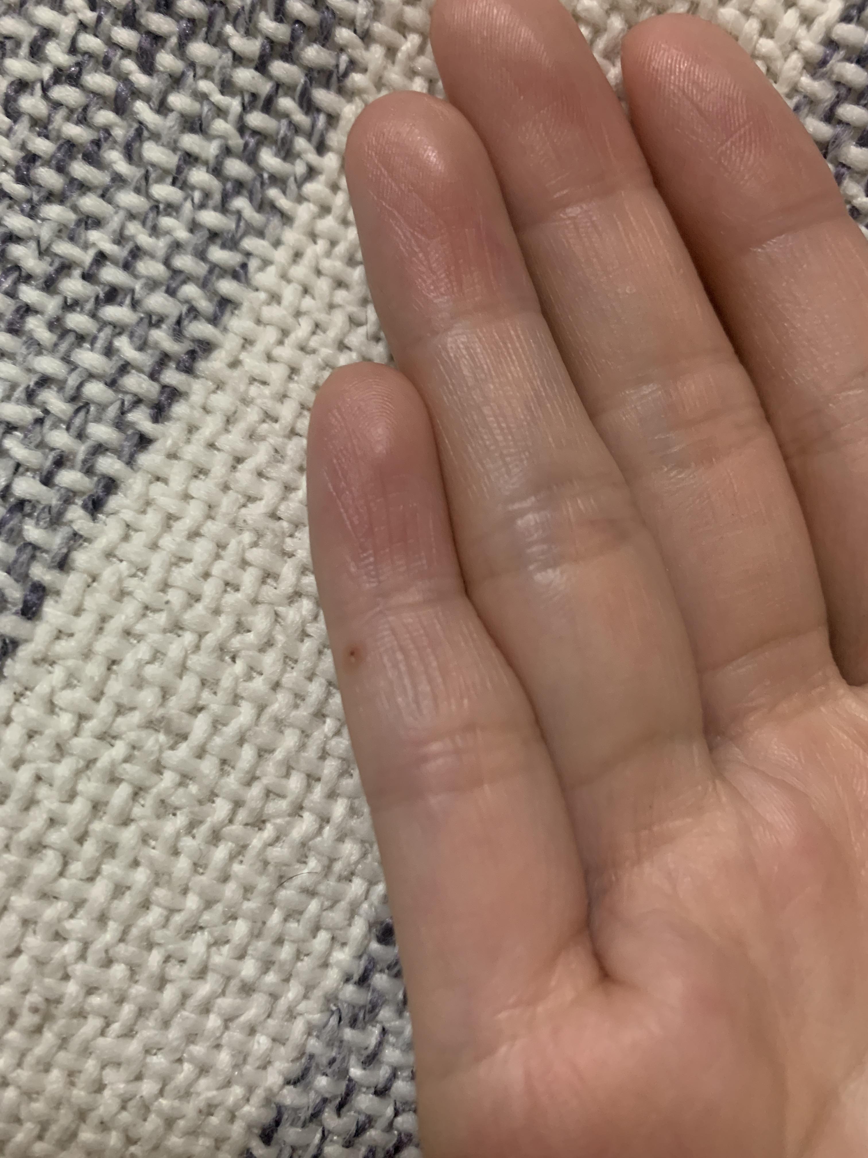 莫吉隆斯症?寄生虫?病毒细菌?诡异病症患者求助(录屏/照片等)2023.6.