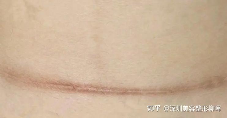 “剖腹产疤痕”怎么修复?激光祛疤有没有用? - 知乎