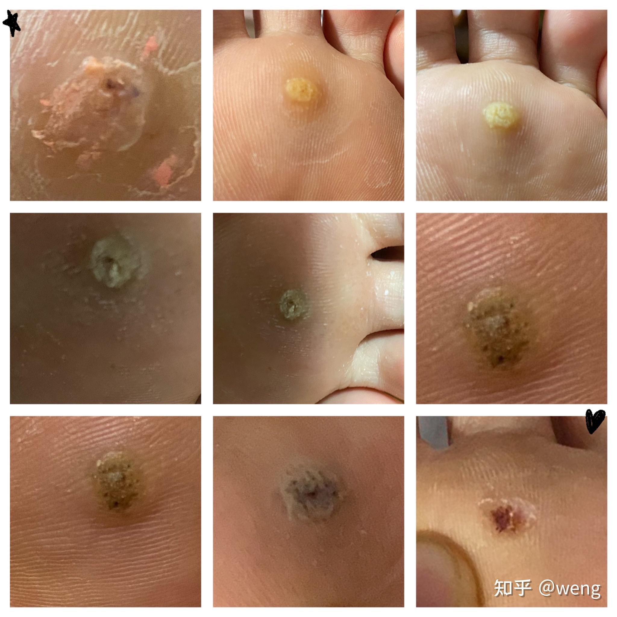 如何在不开刀的情况下去除疣