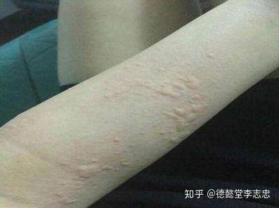 为什么荨麻疹患者不能吃海鲜？