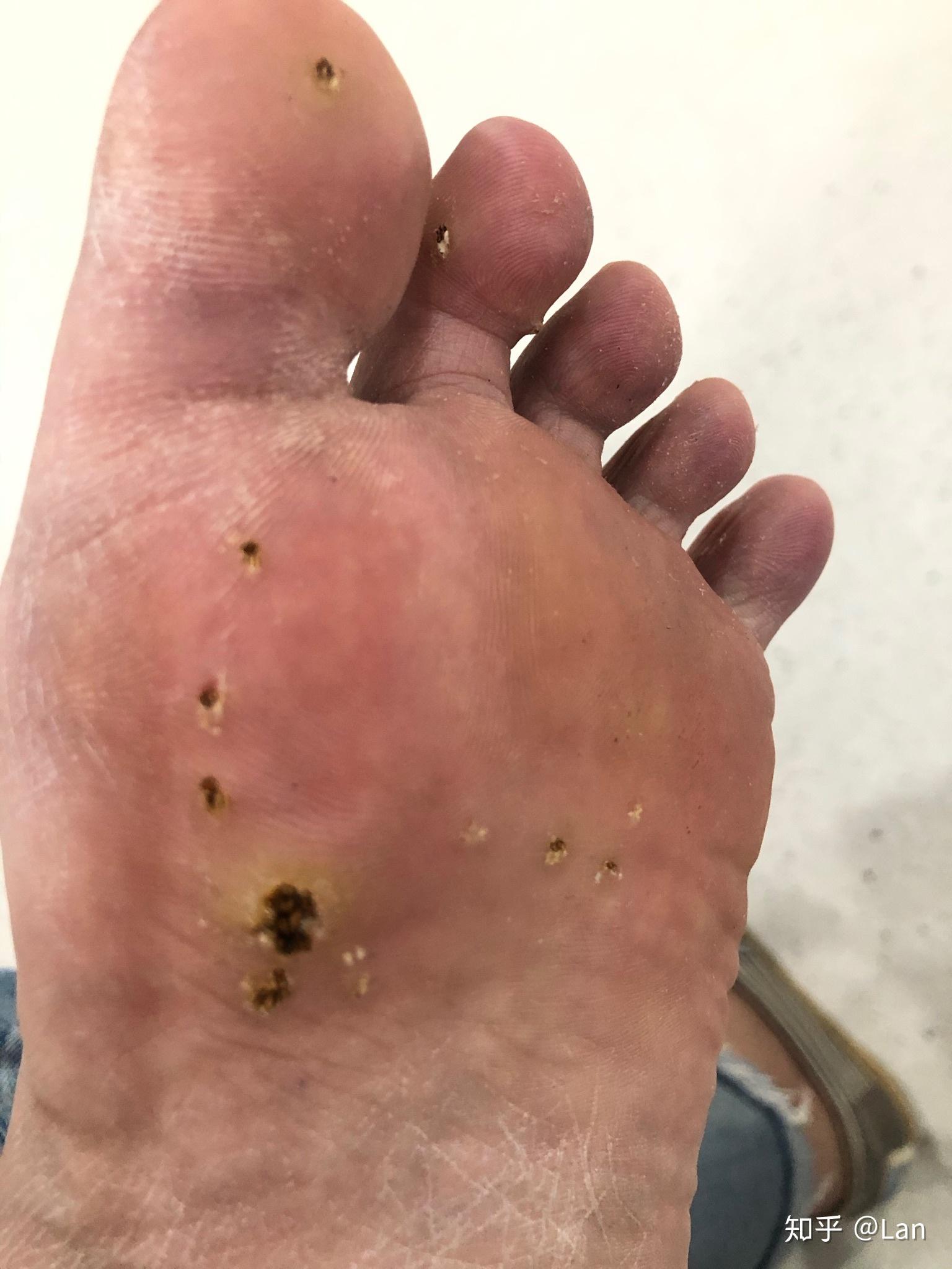 火针治疗跖疣一点感受