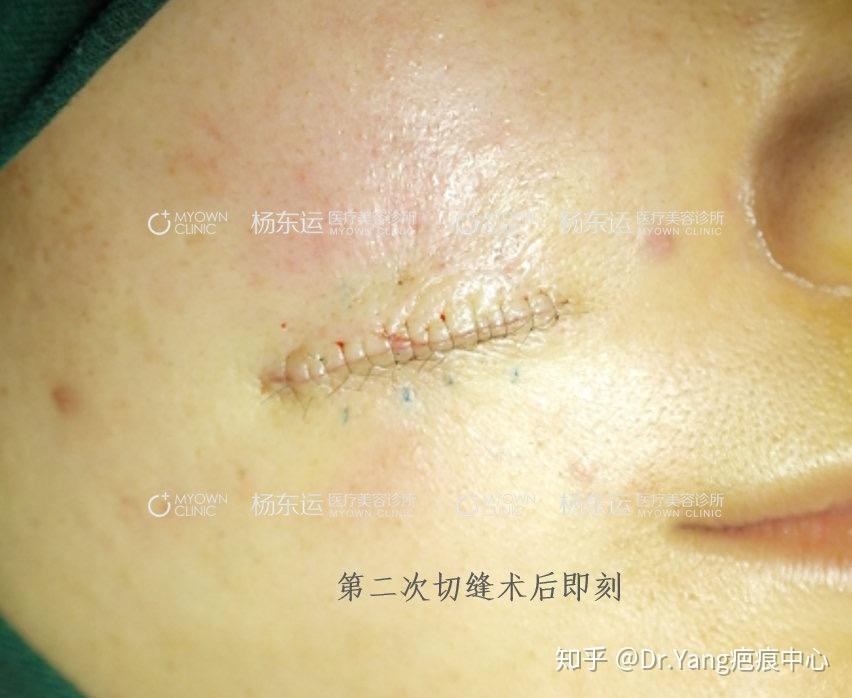 对于这种相邻的两个疤痕,最好做分次切除.