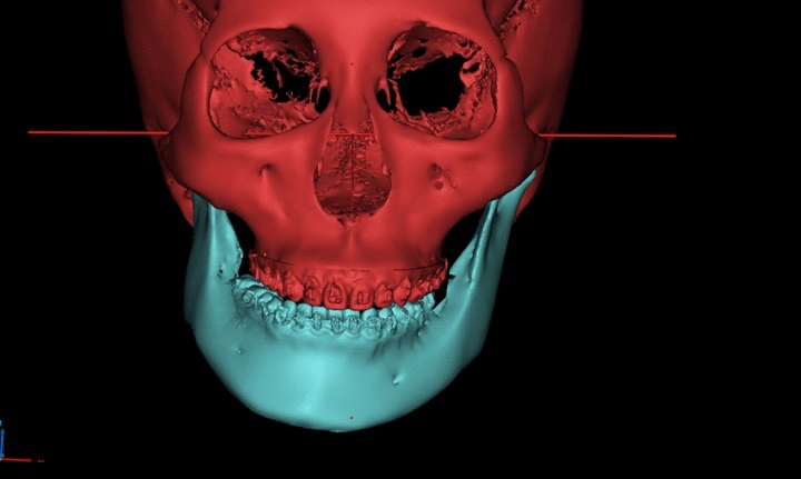 正颌手术动态图图片