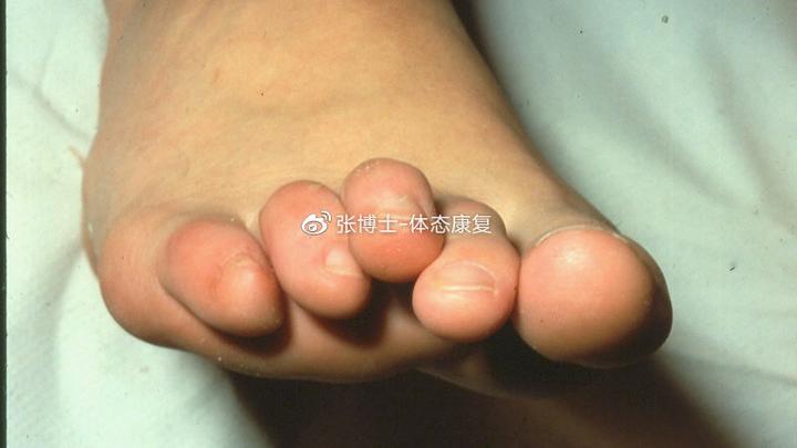 【体态矫正】锤状、爪状、槌状趾是什么?足趾畸形的矫正训练 - 知乎