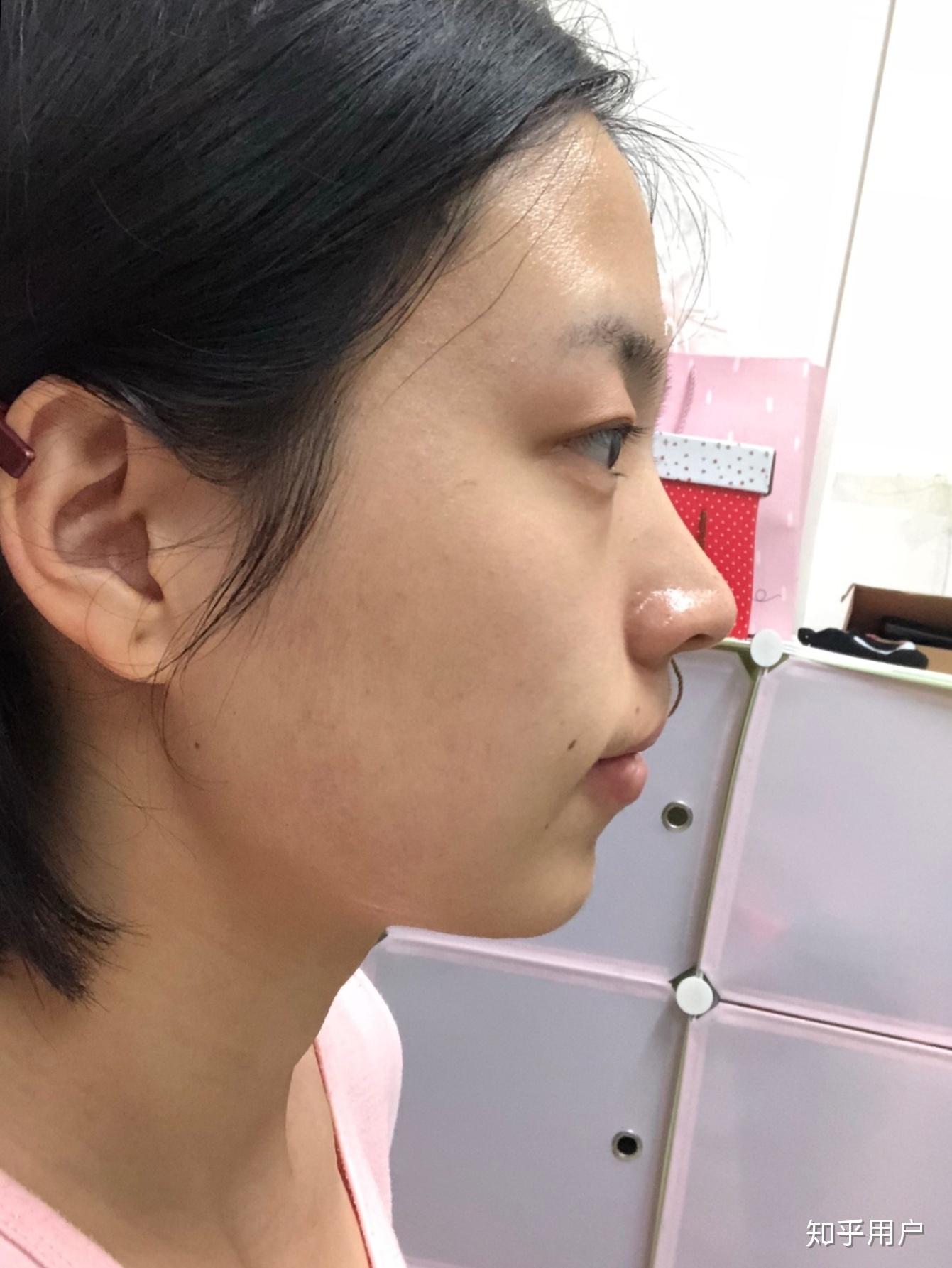 请问我这样是鼻基底塌陷吗? - 知乎