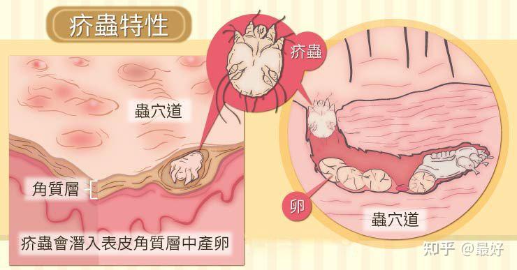 疥疮是什么？有哪些症状呢？ - 知乎