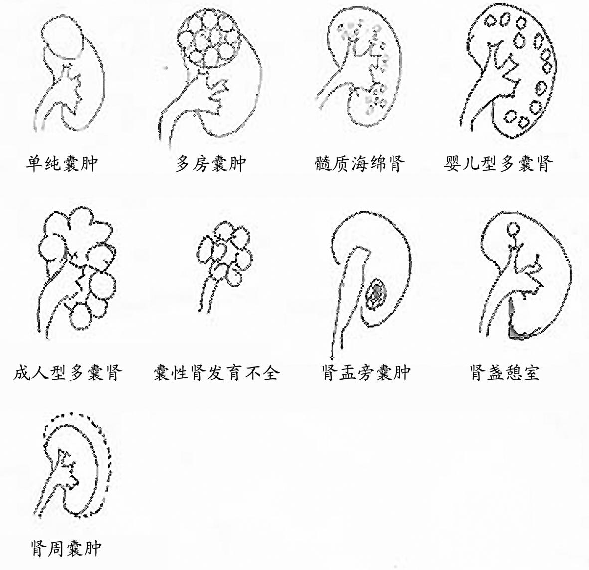 图6-152:肾囊肿分类mri平扫示膀胱右后壁有一菜花状软组织肿块影,t2wi