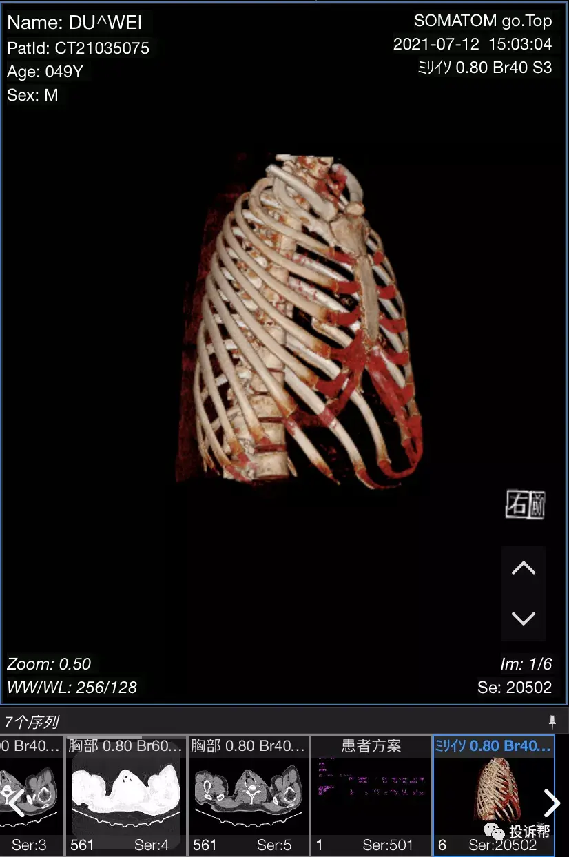 ct检查不出来,又没有长肿瘤,没有破裂,也没有出血……膈肌脚在膈肌