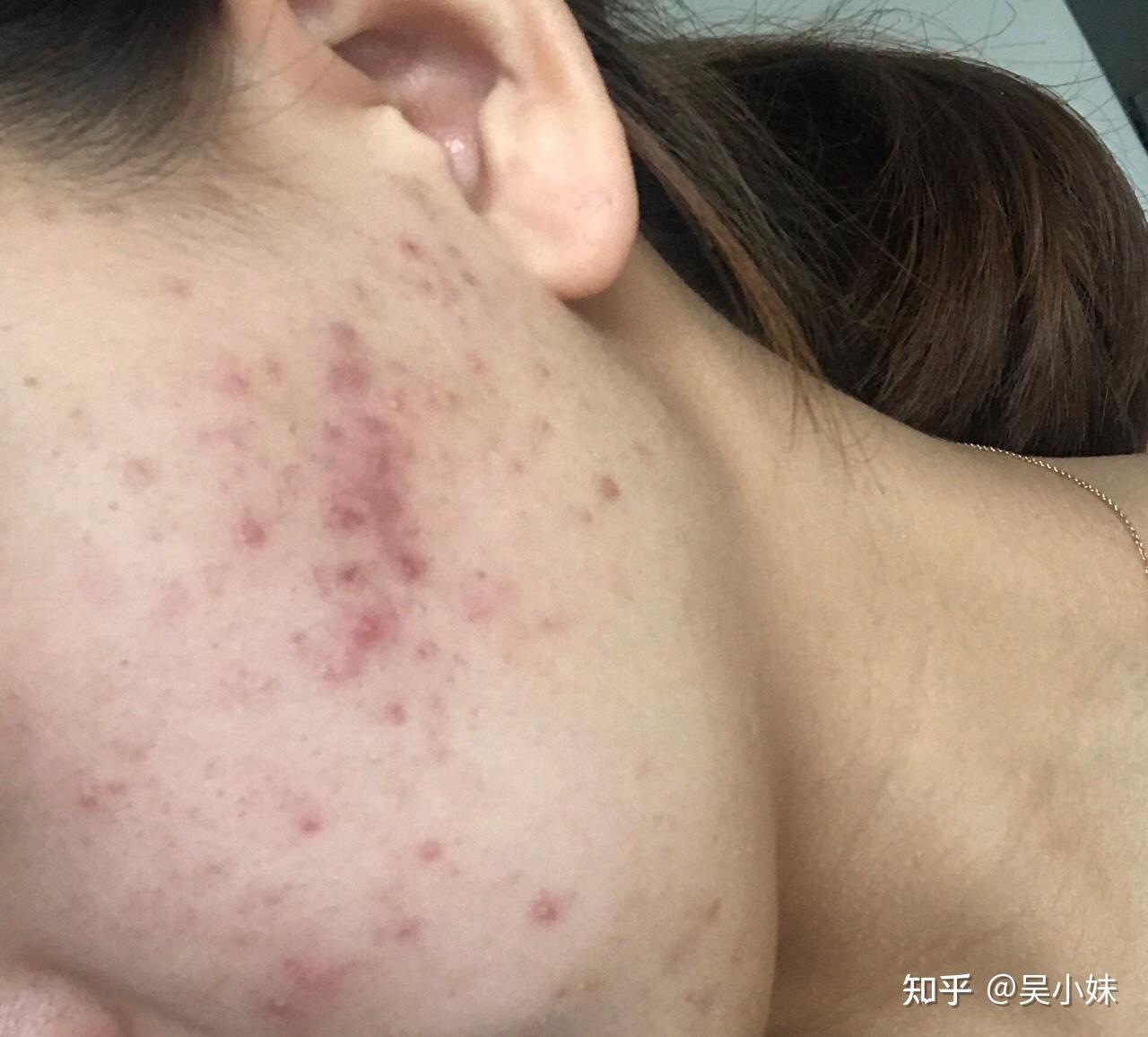 我脸上的红色痘印七八个月了一直不下去我该怎么办